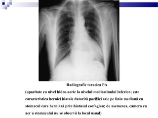 Radiografie toracica PA
(opacitate cu nivel hidro-aeric la nivelul mediastinului inferior; este
caracteristica herniei hiatale datorită pozi iei sale pe linia mediană cuț
stomacul care herniază prin hiatusul esofagian; de asemenea, camera cu
aer a stomacului nu se observă la locul usual)
 
