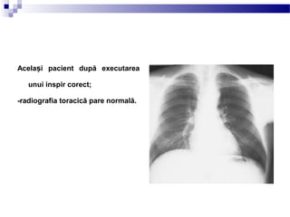 Acela i pacient după executareaș
unui inspir corect;
-radiografia toracică pare normală.
 