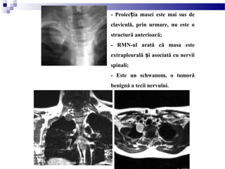 - Proiec ia masei este mai sus deț
claviculă, prin urmare, nu este o
structură anterioară;
- RMN-ul arată că masa este
extrapleurală i asociată cu nerviiș
spinali;
- Este un schwanom, o tumoră
benignă a tecii nervului.
 