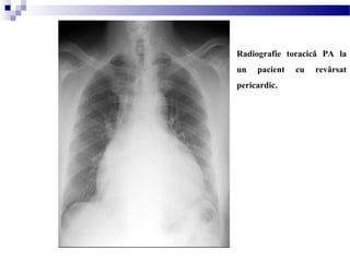 Radiografie toracică PA la
un pacient cu revărsat
pericardic.
 
 