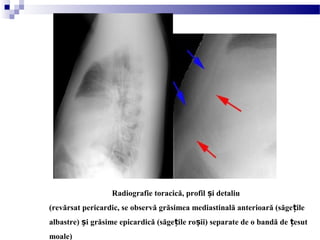 Radiografie toracică, profil i detaliuș
(revărsat pericardic, se observă grăsimea mediastinală anterioară (săge ileț
albastre) i grăsime epicardică (săge ile ro ii) separate de o bandă de esutș ț ș ț
moale)
 