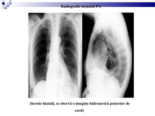 (hernie hiatală, se obervă o imagine hidroaerică posterior de
cord)
Radiografie toracică PA
 