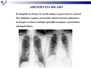 ADENOPATIA HILARĂ
În imaginile de mai jos, în cea din stânga se poate observa conturul
bine delimitat, regulat, caracteristic măririi arterelor pulmonare;
în dreapta se observa multiple opacită i neregulate, caracteristiceț
adenopatii hilare.
 