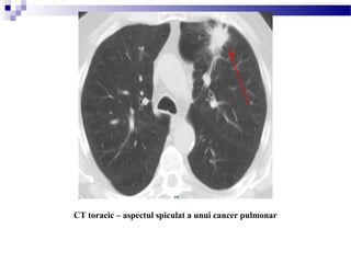 CT toracic – aspectul spiculat a unui cancer pulmonar
 
 