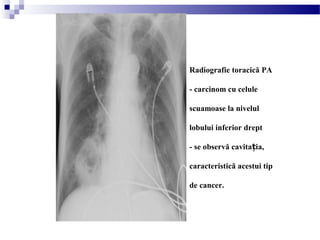 Radiografie toracică PA
- carcinom cu celule
scuamoase la nivelul
lobului inferior drept
- se observă cavita ia,ț
caracteristică acestui tip
de cancer.
 