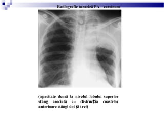 (opacitate densă la nivelul lobului superior
stâng asociată cu distruc ia coastelorț
anterioare stângi doi i treiș )
Radiografie toracică PA – carcinom
 
