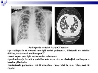 Radiografie toracică PA i CT toracicș
ope radiografie se observă multipli noduli pulmonari, bilaterali, de mărimi
diferite, care se vad mai bine pe CT
oacest aspect este tipic metastazelor pulmonare
opredominan a bazală a nodulilor este datorită vasculariza iei mai bogate aț ț
bazelor plămânilor
ometastazele pulmonare pot fi secundare cancerului de sân, colon, rect iș
rinichi
 