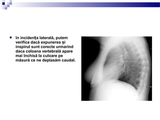  în inciden a laterală, putemț
verifica dacă expunerea iș
inspirul sunt corecte urmarind
daca coloana vertebrală apare
mai închisă la culoare pe
măsură ce ne deplasăm caudal.
 