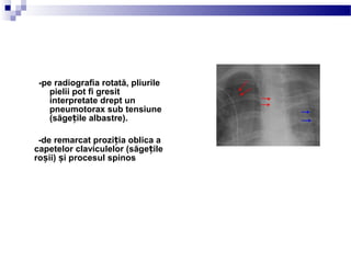 -pe radiografia rotată, pliurile
pielii pot fi gresit
interpretate drept un
pneumotorax sub tensiune
(săge ile albastre).ț
-de remarcat prozi ia oblica aț
capetelor claviculelor (săge ileț
ro ii) i procesul spinosș ș
 