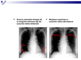  Marginea superioara a
scizurilor oblice (B) bilateral
 Scizura orizontala dreapta (A)
si marginile inferioare (B) ale
scizurilor oblice bilaterale
 