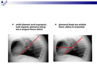  ambii plamani sunt suprapusi,
luati separat, plamanul stang
are o singura fisura oblica
 plamanul drept are ambele
fisuri, oblica si orizontala
 