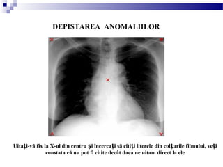 DEPISTAREA ANOMALIILOR
Uita i-vă fix la X-ul din centru i încerca i să citi i literele din col urile filmului, ve iț ș ț ț ț ț
constata că nu pot fi citite decât daca ne uitam direct la ele
 