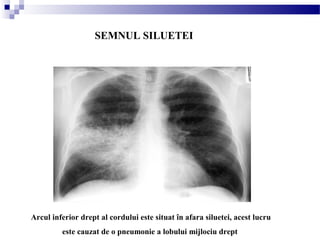 SEMNUL SILUETEI
Arcul inferior drept al cordului este situat în afara siluetei, acest lucru
este cauzat de o pneumonie a lobului mijlociu drept
 