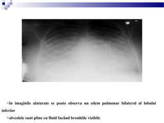 oîn imaginile alaturate se poate observa un edem pulmonar bilateral al lobului
inferior
oalveolele sunt pline cu fluid facând bronhiile vizibile
 
