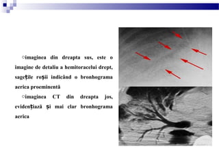 oimaginea din dreapta sus, este o
imagine de detaliu a hemitoracelui drept,
sage ile ro ii indicând o bronhogramaț ș
aerica proeminentă
oimaginea CT din dreapta jos,
eviden iază i mai clar bronhogramaț ș
aerica 
 