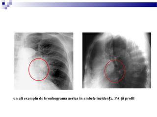 un alt exemplu de bronhograma aerica în ambele inciden e, PA i profilț ș
 