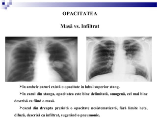 OPACITATEA
Masă vs. Infiltrat
în ambele cazuri există o opacitate in lobul superior stang.
în cazul din stanga, opacitatea este bine delimitată, omogenă, cel mai bine
descrisă ca fiind o masă.
cazul din dreapta prezintă o opacitate nesistematizată, fără limite nete,
difuză, descrisă ca infiltrat, sugerând o pneumonie.   
 