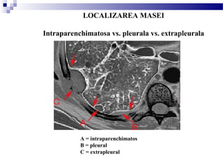 LOCALIZAREA MASEI
Intraparenchimatosa vs. pleurala vs. extrapleurala
A = intraparenchimatos
B = pleural
C = extrapleural 
 