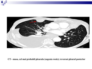 CT - masa, cel mai probabil pleurala (sageata rosie); revarsat pleural posterior 
 