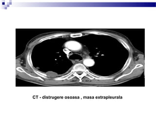 CT - distrugere osoasa , masa extrapleurala
 
