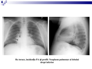 Rx torace, inciden a PA i profil: Neoplasm pulmonar al lobuluiț ș
drept inferior
 