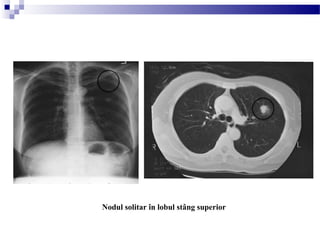 Nodul solitar în lobul stâng superior
 