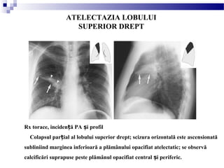 ATELECTAZIA LOBULUI
SUPERIOR DREPT
Rx torace, inciden ă PA i profilț ș
Colapsul par ial al lobului superior drept; scizura orizontală este ascensionatăț
subliniind marginea inferioară a plămânului opacifiat atelectatic; se observă
calcificări suprapuse peste plămânul opacifiat central i periferic.ș
 