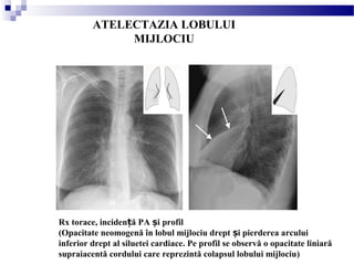 ATELECTAZIA LOBULUI
MIJLOCIU
Rx torace, inciden ă PA i profilț ș
(Opacitate neomogenă în lobul mijlociu drept i pierderea arculuiș
inferior drept al siluetei cardiace. Pe profil se observă o opacitate liniară
supraiacentă cordului care reprezintă colapsul lobului mijlociu)
 