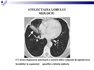 ATELECTAZIA LOBULUI
MIJLOCIU
CT torace deplasarea anterioară a scizurii oblice (săgeată) i aglomerareaș
bronhiilor în segmentul opacifiat a lobului mijlociu
 