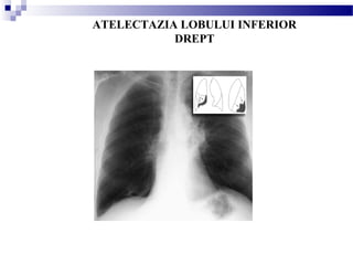 ATELECTAZIA LOBULUI INFERIOR
DREPT
 