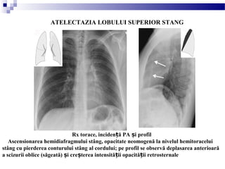 ATELECTAZIA LOBULUI SUPERIOR STANG
Rx torace, inciden ă PA i profilț ș
Ascensionarea hemidiafragmului stâng, opacitate neomogenă la nivelul hemitoracelui
stâng cu pierderea conturului stâng al cordului; pe profil se observă deplasarea anterioară
a scizurii oblice (săgeată) i cre terea intensită ii opacită ii retrosternaleș ș ț ț
 
