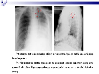 Colapsul lobului superior stâng, prin obstruc ia de către un carcinomț
bronhogenic .
Transparen a dintre mediastin i colapsul lobului superior stâng esteț ș
cauzată de către hiperexpansiunea segmentului superior a lobului inferior
stâng.
 