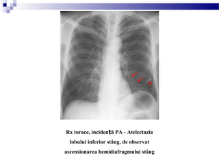 Rx torace, inciden ă PA - Atelectaziaț
lobului inferior stâng, de observat
ascensionarea hemidiafragmului stâng
 