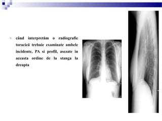 o când interpretăm o radiografie
toracică trebuie examinate ambele
incidente, PA si profil, asezate in
aceasta ordine de la stanga la
dreapta
 