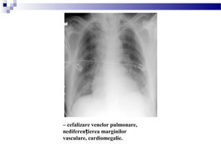 – cefalizare venelor pulmonare,
nediferen ierea marginilorț
vasculare, cardiomegalie.
 