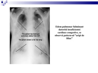 Edem pulmonar fulminant
datorită insuficientei
cardiace congestive, se
observă pattern-ul ”aripi de
liliac”
 