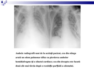 Ambele radiografii sunt de la acela i pacient, cea din stângaș
arată un edem pulmonar difuz cu pierderea ambelor
hemidiafragme i a siluetei cardiace; cea din dreapta este facutăș
două zile mai târziu după o rezolu ie par ială a edemului.ț ț
 