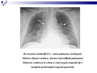 Rx toracică, inciden ă PA – edem pulmonar cardiogenicț
Mărirea siluetei cardiace, afectare intersti ială pulmonarăț
bilateral, cre terea în volum a venei azygos (sageată) i oș ș
man etă peribron ică (săgeată punctată)ș ș
 