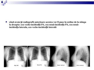  când avem i radiografii anterioare acestea vor fi puse în ordine de la stângaș
la dreapta: cea veche-inciden ă PA, cea nouă-inciden a PA, cea nouă-ț ț
inciden a laterala, cea veche-inciden ă lateralăț ț
 
