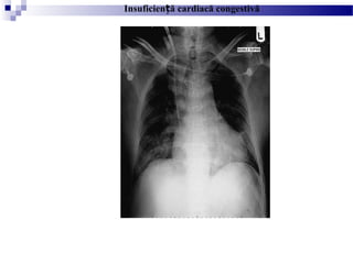 Insuficien ă cardiacă congestivăț
 