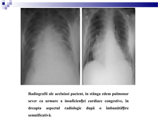 Radiografii ale aceluiasi pacient, in stânga edem pulmonar
sever ca urmare a insuficien ei cardiace congestive, înț
dreapta aspectul radiologic după o îmbunătă ireț
semnificativă.
 