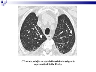 CT torace, sub ierea septului interlobular (săgeată)ț
reprezentând liniile Kerley
 