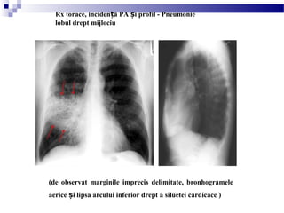 (de observat marginile imprecis delimitate, bronhogramele
aerice i lipsa arcului inferior drept a siluetei cardicace )ș
Rx torace, inciden ă PA i profil - Pneumonieț ș
lobul drept mijlociu
 