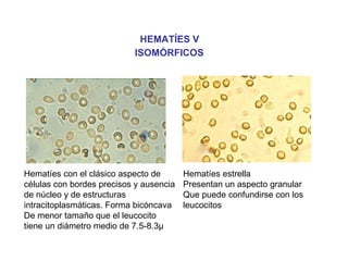HEMATÍES V
                           ISOMÓRFICOS




Hematíes con el clásico aspecto de       Hematíes estrella
células con bordes precisos y ausencia   Presentan un aspecto granular
de núcleo y de estructuras               Que puede confundirse con los
intracitoplasmáticas. Forma bicóncava    leucocitos
De menor tamaño que el leucocito
tiene un diámetro medio de 7.5-8.3µ
 