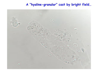 A “hyaline-granular” cast by bright field…
 