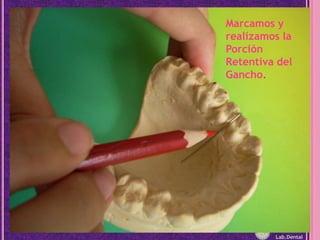 Marcamos y realizamos la Porción Retentiva del Gancho.Lab.Dental
