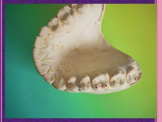 Introducciòn Lab. Dental - Pròtesis Fija