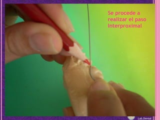 Se procede a realizar el paso InterproximalLab.Dental