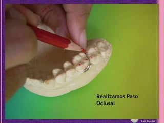 Realizamos Paso OclusalLab.Dental
