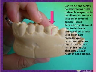 Consta de dos partes de alambre las cuales rodean la mayor parte del diente en su cara vestibular como el gancho TorresPara esto dividimos el diente de forma trasversal en la cara vestibular para recordar que debemos conservar una distancia de 1 mm entre los dos alambres y llegar hasta la zona gingivalLab.Dental